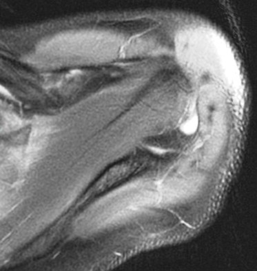 Figure 3 for case scapular fracture and supraspinatus and subscapularis muscle strain ( RID1860 ) ( RID1870 )